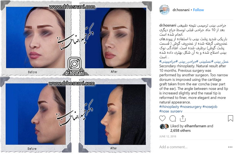 revision rhinoplasty after 10 months
