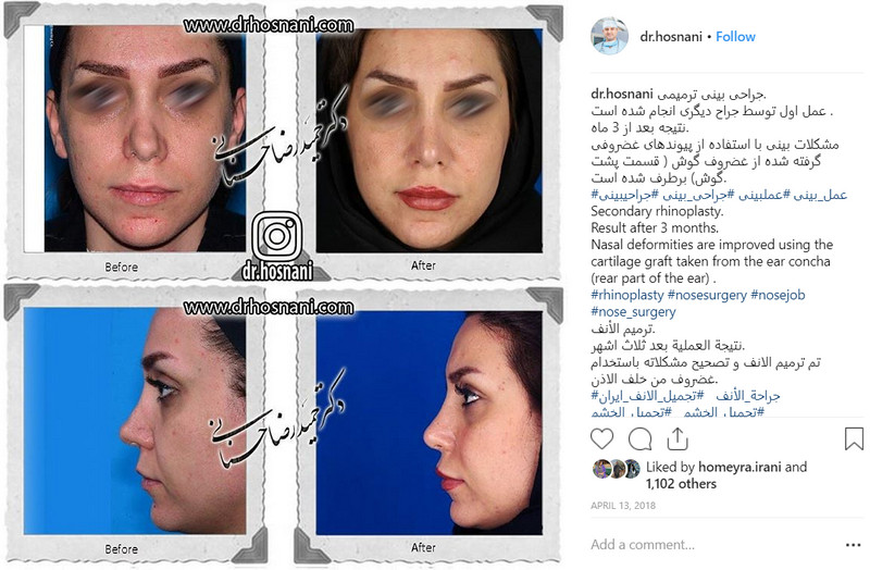 revision rhinoplasty after 3 months ear cartilage