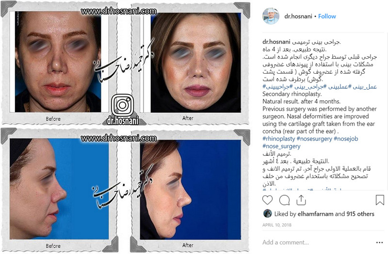 revision rhinoplasty after 4 months