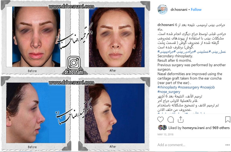 revision rhinoplasty after 6 months