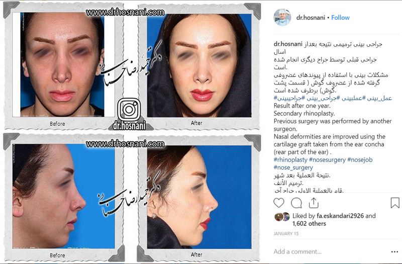 revision rhinoplasty after one year