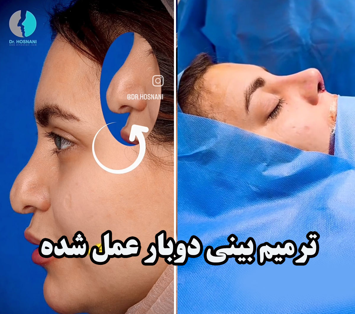 جراحی بینی ترمیمی بعد از دو بار عمل ناموفق!