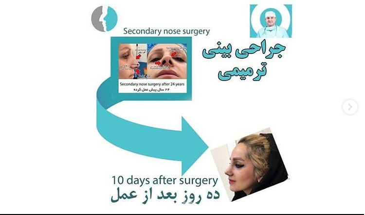 revision rhinoplasty og