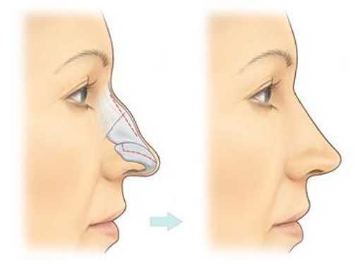 rhinoplasty for broken nose og