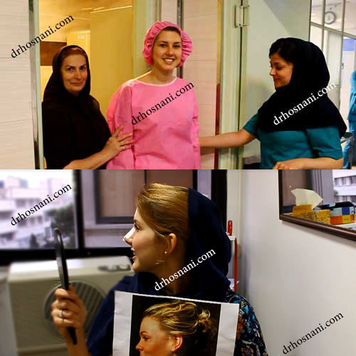 rhinoplasty in iran og