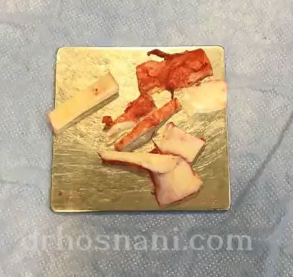 غضروف های دنده برش خورده