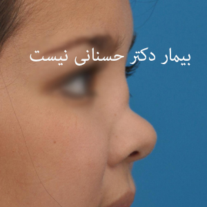 saddle nose deformity