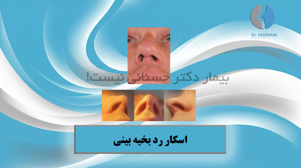 اسکار رد بخیه بینی