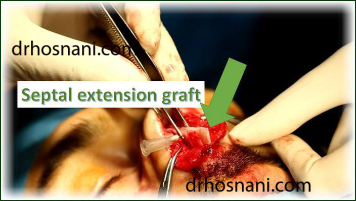 septal extension graft