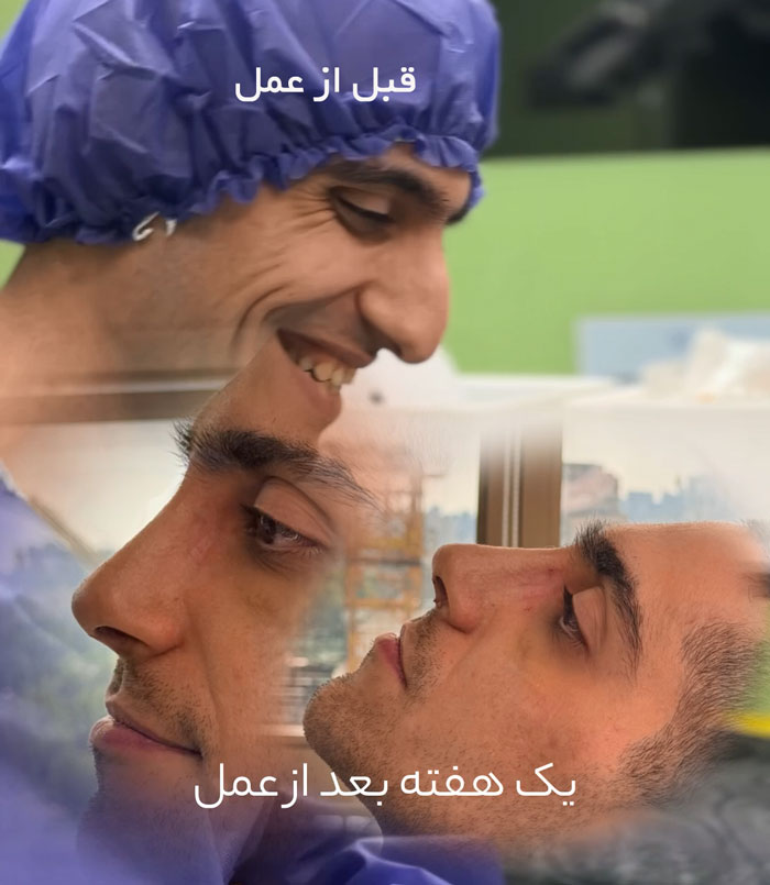 جراحی بینی استخوانی