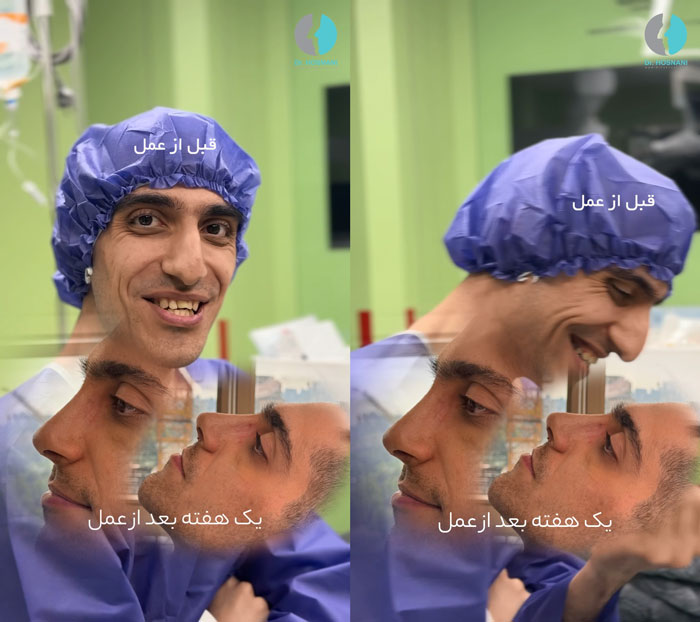 تغییرات واضح بینی و چهره بعد از عمل