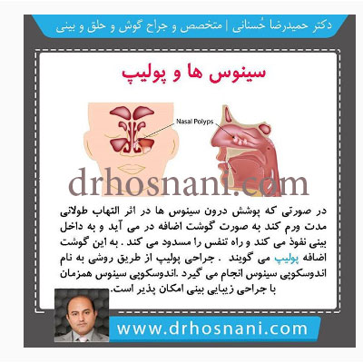 sinus and polyps