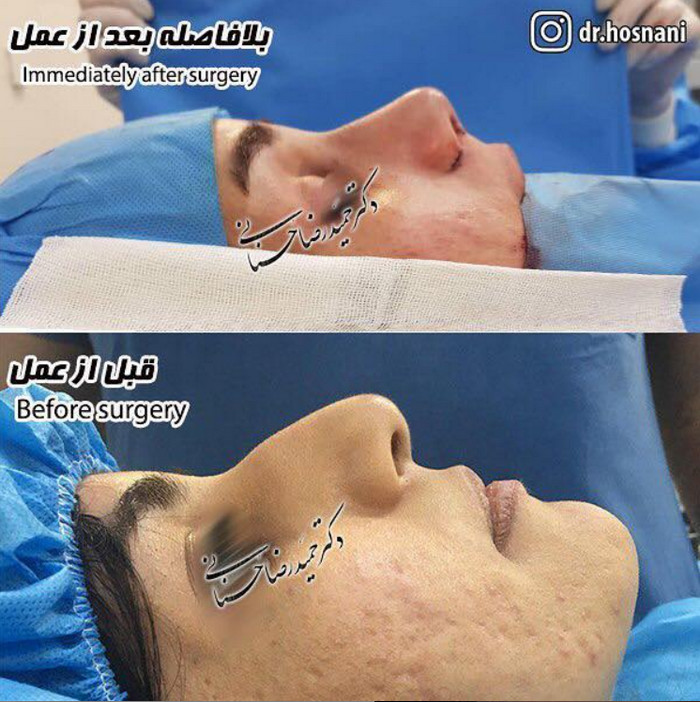 smaller nose 97