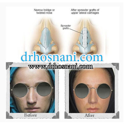 spreader graft2