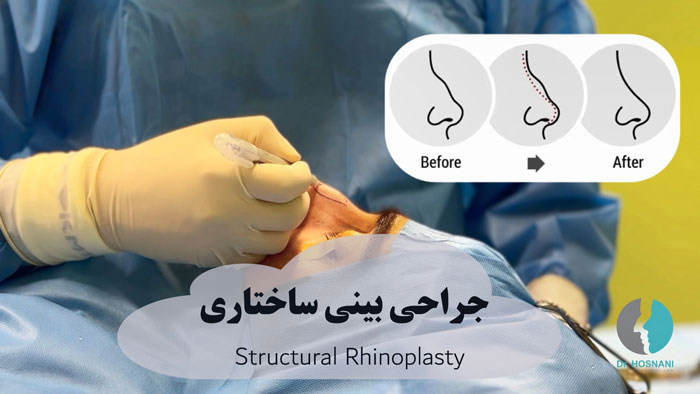 استراکچرال رینوپلاستی