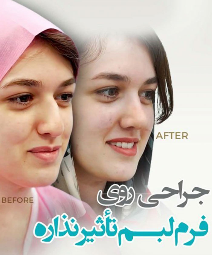 قبل و بعد بینی گوشتی