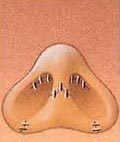 sutures