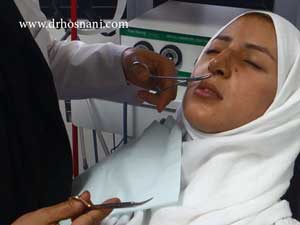 suture removal