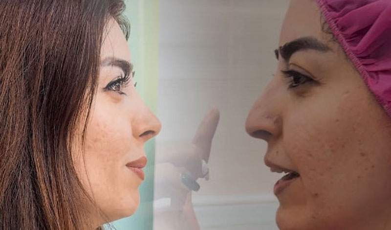 نوک بینی موقع خنده افتاده بود؟ حالا دیگه نیست!