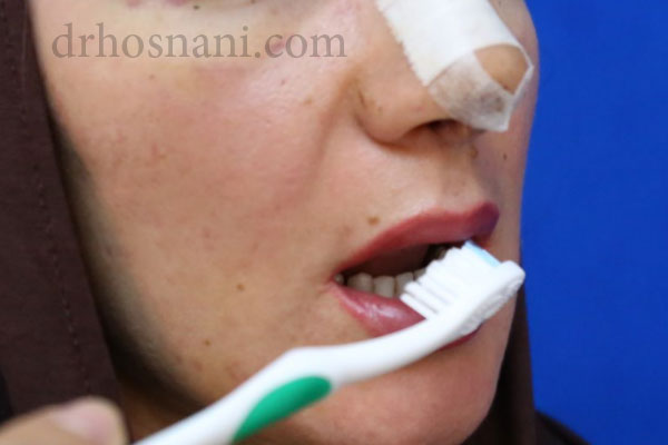 مسواک بعد از عمل بینی