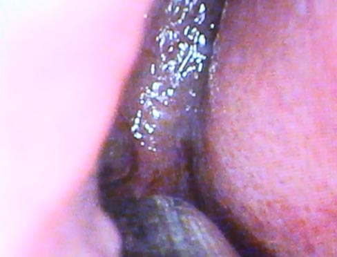turbinate middle