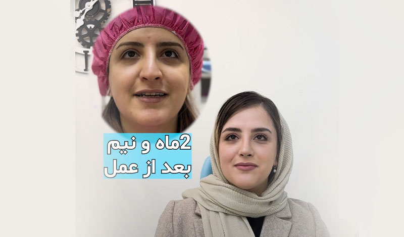 بینی طبیعی دو ماه بعد از عمل: مسافری از کانادا