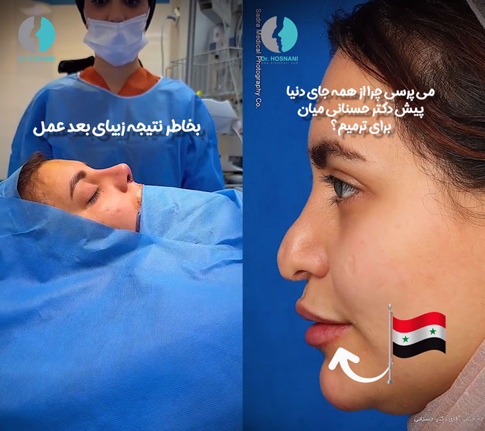 why do revision rhinoplasty with drhosnani