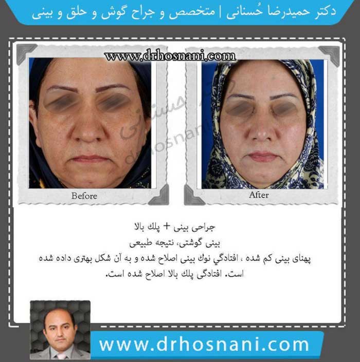 woman eyelids and nosejob by drhosnani